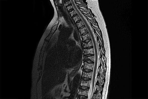 Manifestationen der thorakalen Osteochondrose im Bild der Magnetresonanz