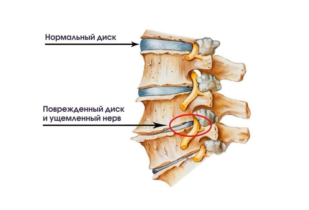 Zervikale Osteochondrose -Symptome