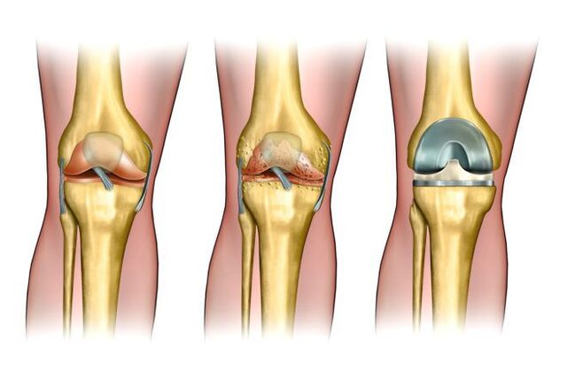 Grad der Arthrose