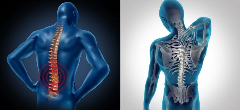 Entzündung bei spinaler Osteochondrose.