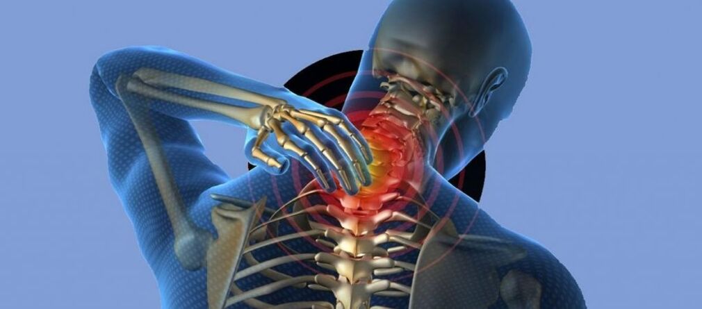 Osteochondrose der Halswirbelsäule.