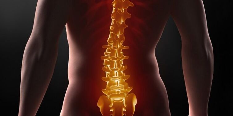 Osteochondrose der Kreuzwirbelsäule.