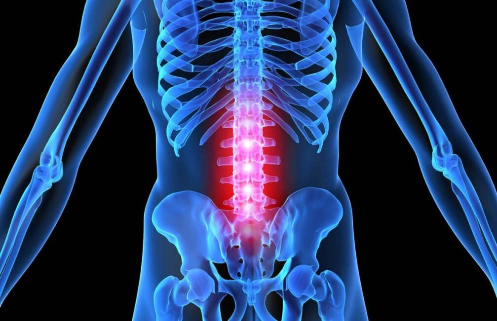 Osteochondrose der Lendenwirbelsäule.